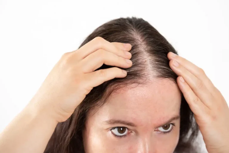 Hair Loss in Women Different Solutions